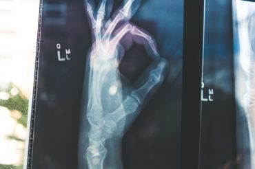 Dieta w reumatoidalnym zapaleniu stawów + dzień diety do pobrania